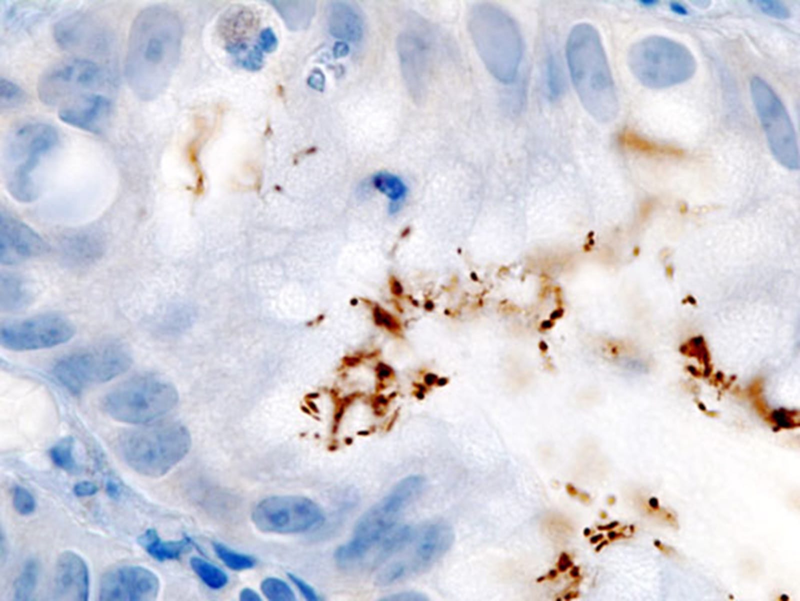 Impactul infecțiilor asupra incidenței globale a cancerului