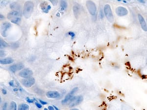 Impactul infecțiilor asupra incidenței globale a cancerului