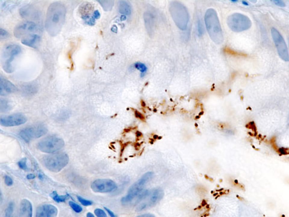 Impactul infecțiilor asupra incidenței globale a cancerului