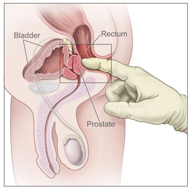 Biopsie prostatica - Synevo