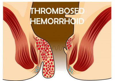 tromboza-hemoroidala-externa