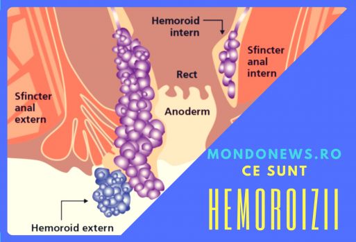 Ce sunt hemoroizii