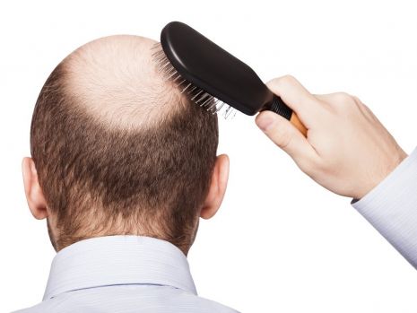 căderea părului, pierderea părului, alopecia, prevenție, prevenire căderea părului